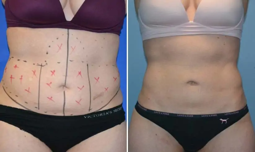 female liposuction before (left) and after (right)