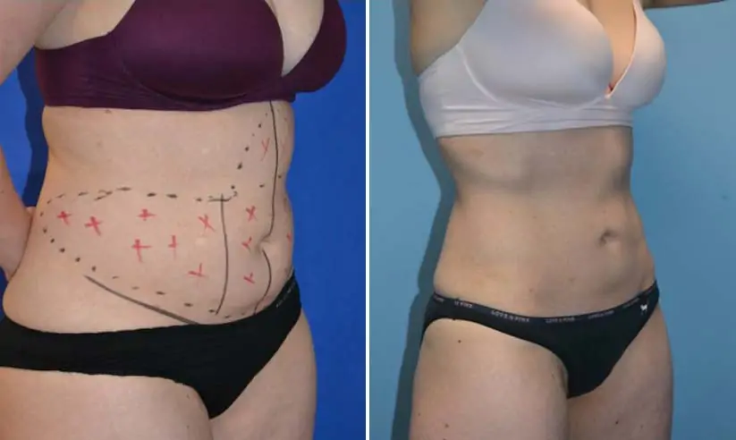 female liposuction before (left) and after (right)