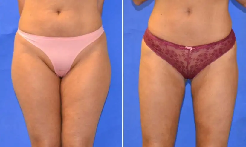 female liposuction before (left) and after (right)