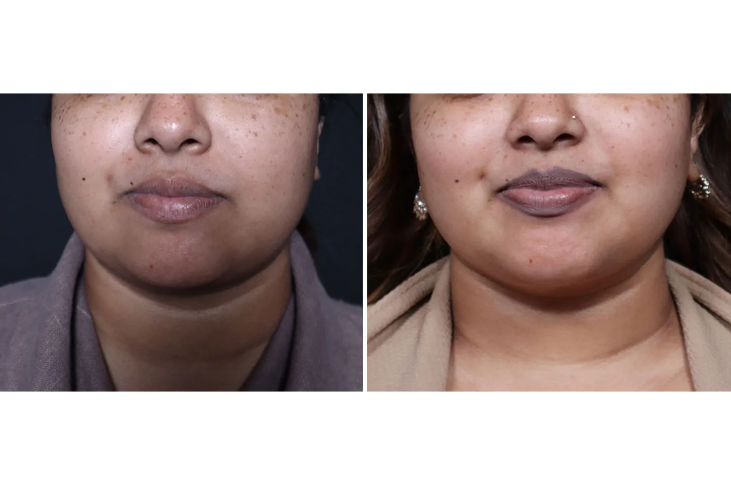 Female non-surgical neck and jawline contouring before (left) and after (right), frontal view