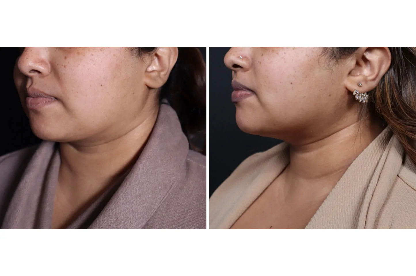 Female non-surgical neck and jawline contouring before (left) and after (right), left oblique view