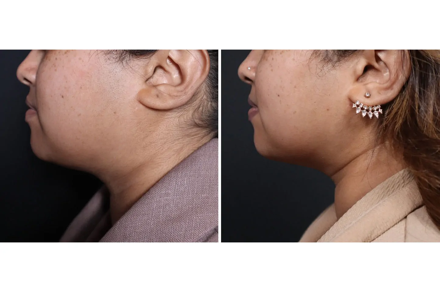 Female non-surgical neck and jawline contouring before (left) and after (right), left lateral view