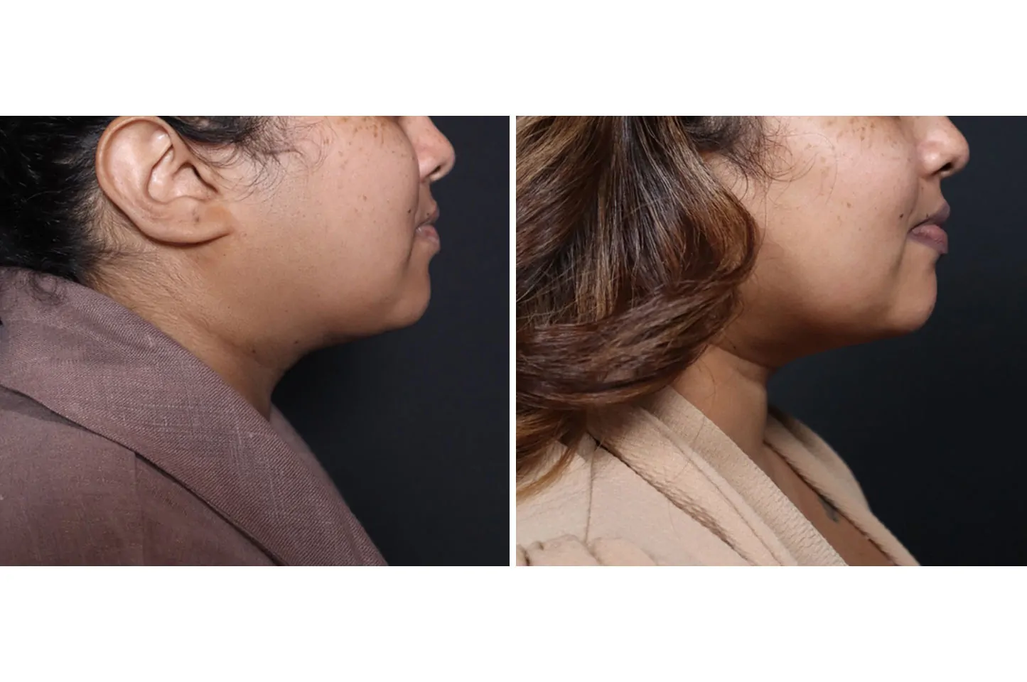 Female non-surgical neck and jawline contouring before (left) and after (right), right lateral view