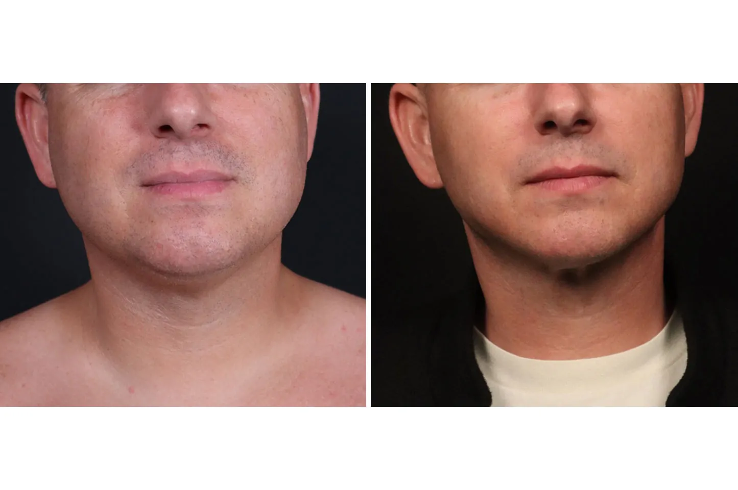 Male non-surgical neck and jawline contouring before (left) and after (right), frontal view