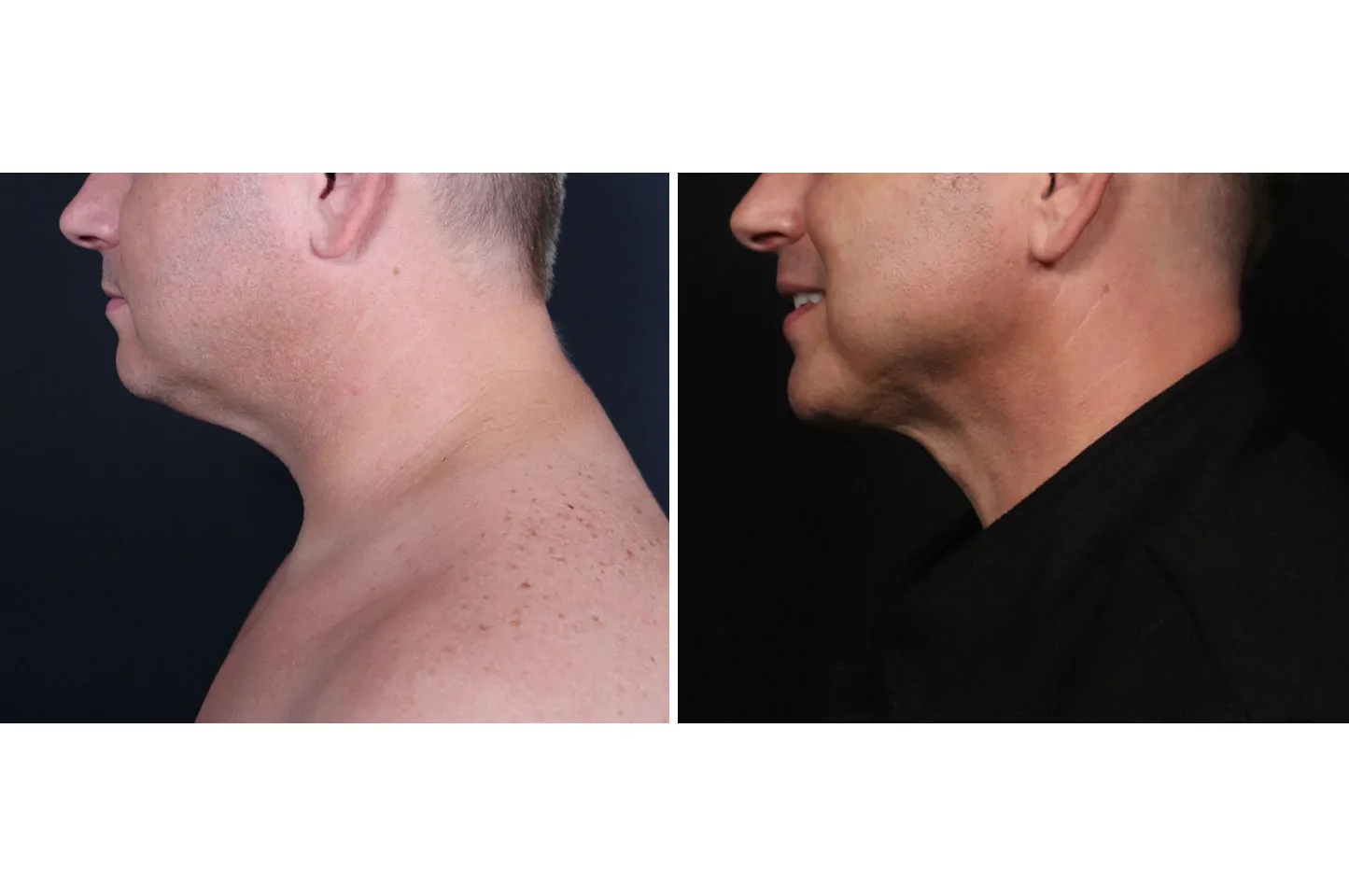 Male non-surgical neck and jawline contouring before (left) and after (right), left lateral view