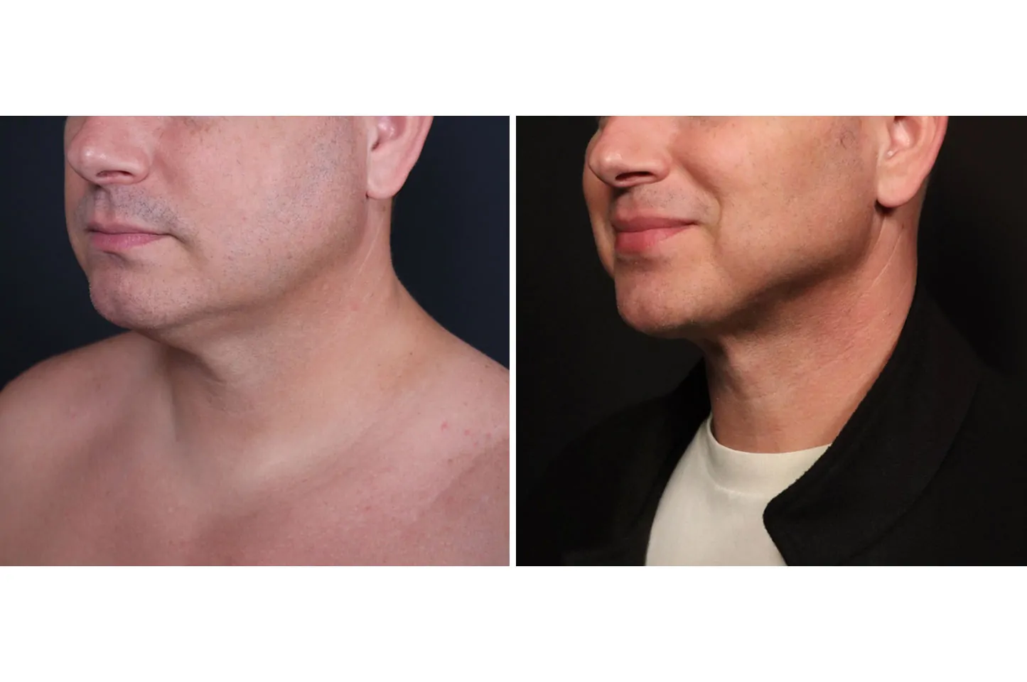 Male non-surgical neck and jawline contouring before (left) and after (right), left oblique view