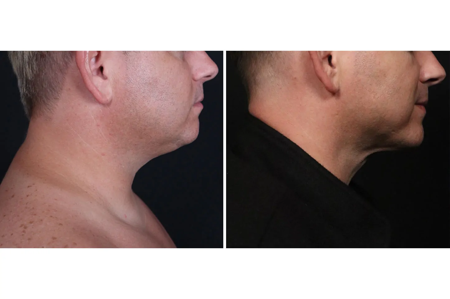 Male non-surgical neck and jawline contouring before (left) and after (right), right lateral view