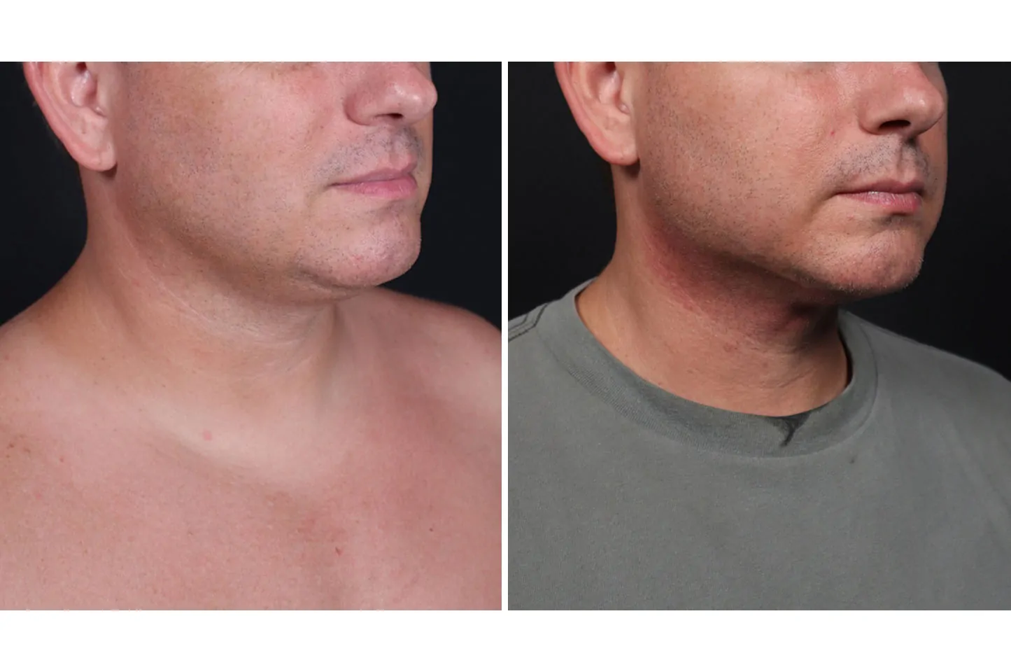 Male non-surgical neck and jawline contouring before (left) and after (right), right oblique view