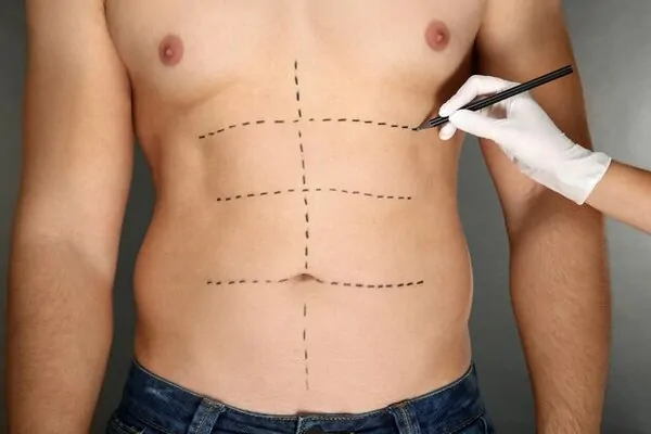 Men getting ready for liposuction