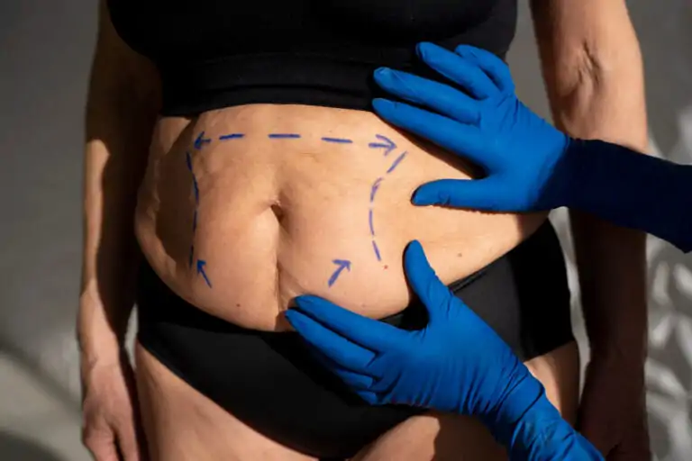 Liposuction surgery