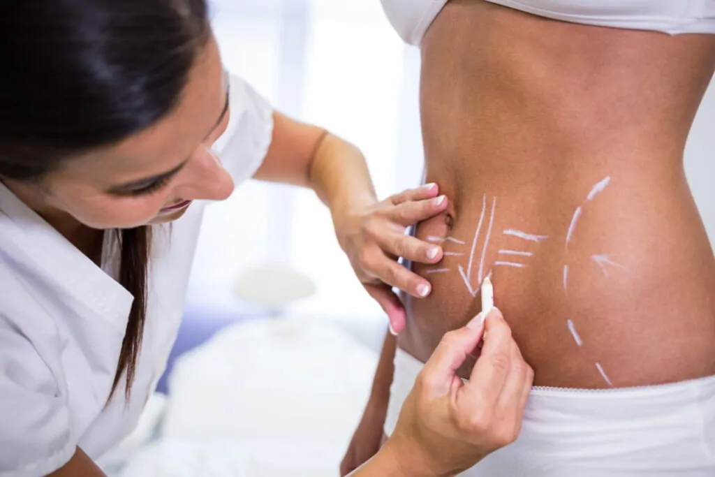 A woman who wants to undergo liposuction