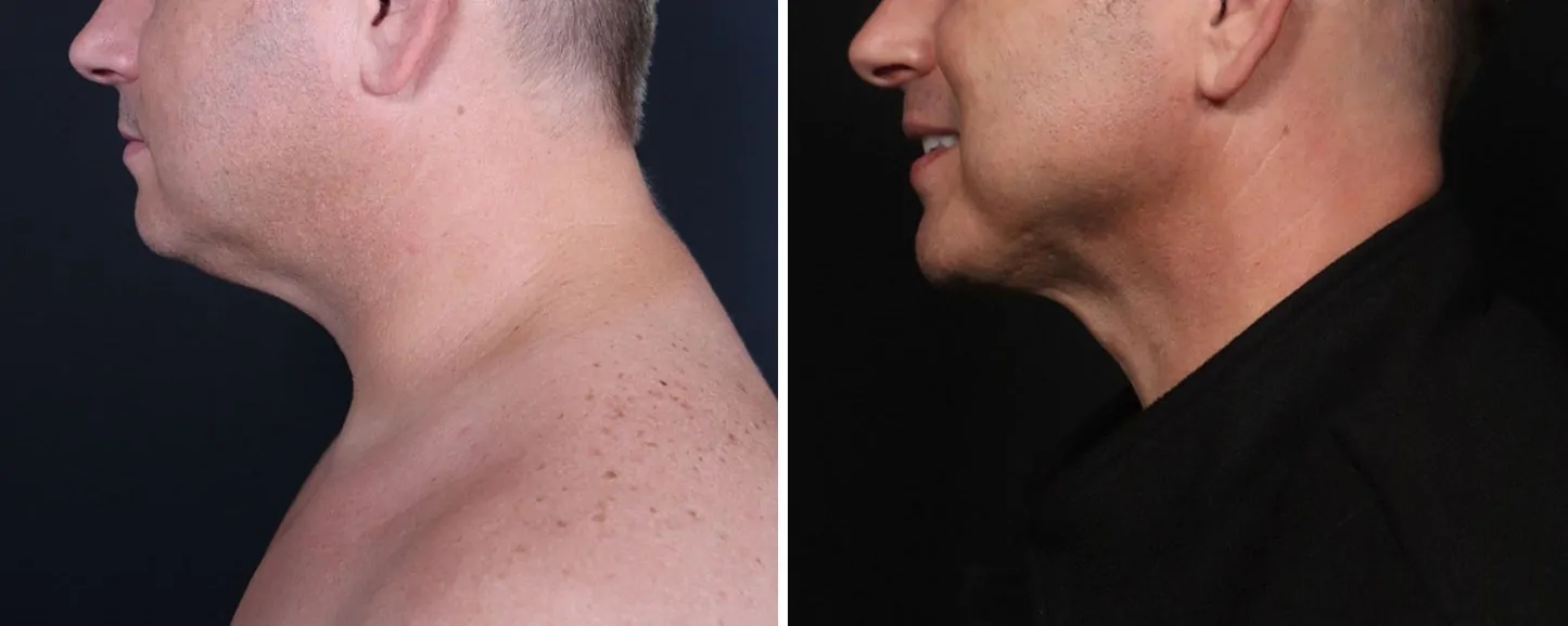before and after neck liposuction procedure