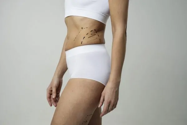 A woman with marker traces for liposuction.