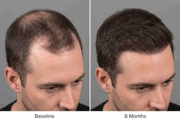 Before and after crown density at six months following a series of PRP hair treatments