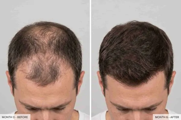 Hair density before and after PRP combined with daily topical minoxidil