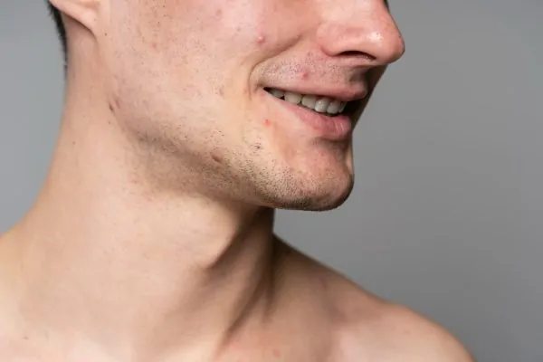 Close-up side profile showing facial skin texture and injection site areas, illustrating Botox treatment results and skin care concerns