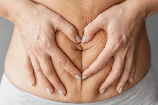 Hands forming heart shape over abdomen with loose skin and stretch marks, illustrating post-operative care and recovery area for abdominoplasty patients