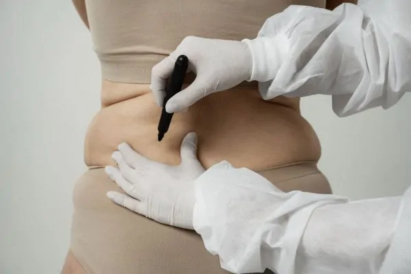 Surgeon marking abdominal area for liposuction treatment planning and body contouring assessment