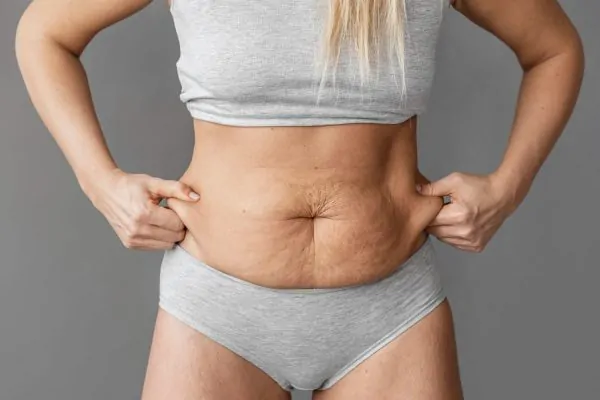 Woman showing excess abdominal skin and loose tissue before tummy tuck surgery to address swelling concerns