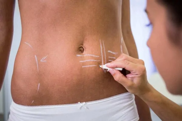 Surgeon drawing lines on womans abdomen for liposuction