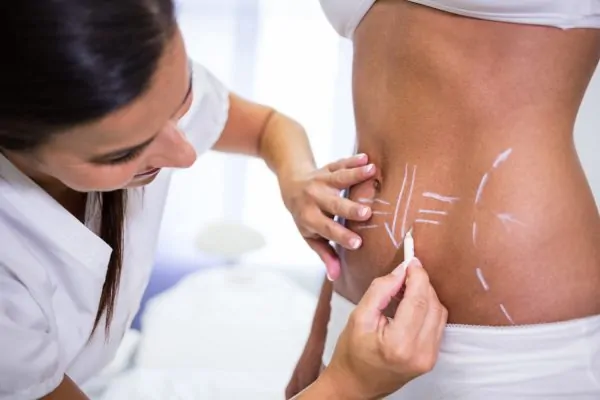 Surgeon drawing lines on womans abdomen for liposuction